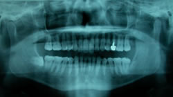 歯科用パノラマ撮影写真